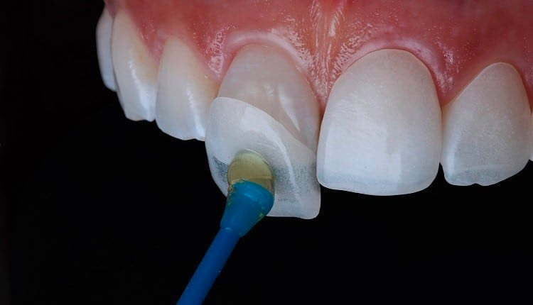 durable are dental veneers