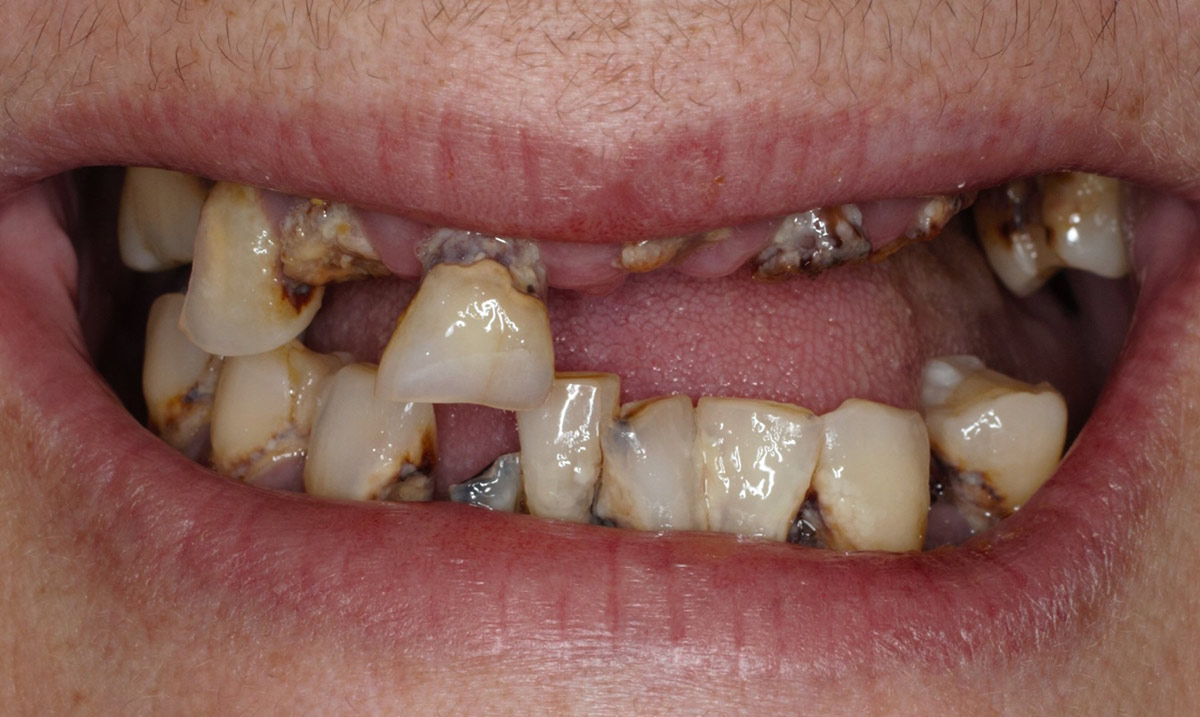 Dental-Implant-Before