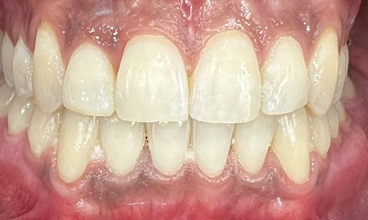 Teeth-Whitening-2-After