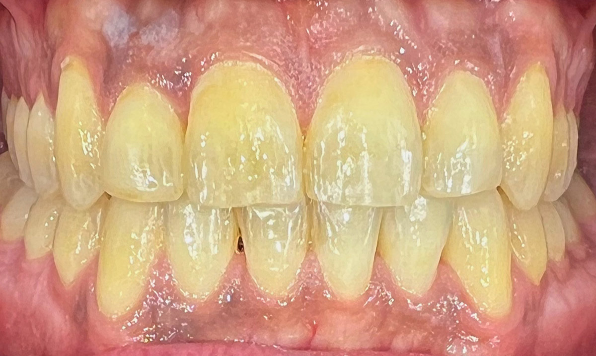 Teeth-Whitening-2-Before