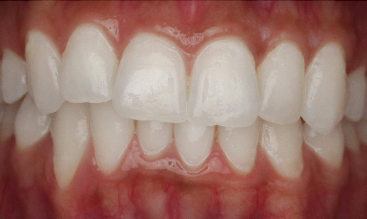 Teeth-Whitening-After