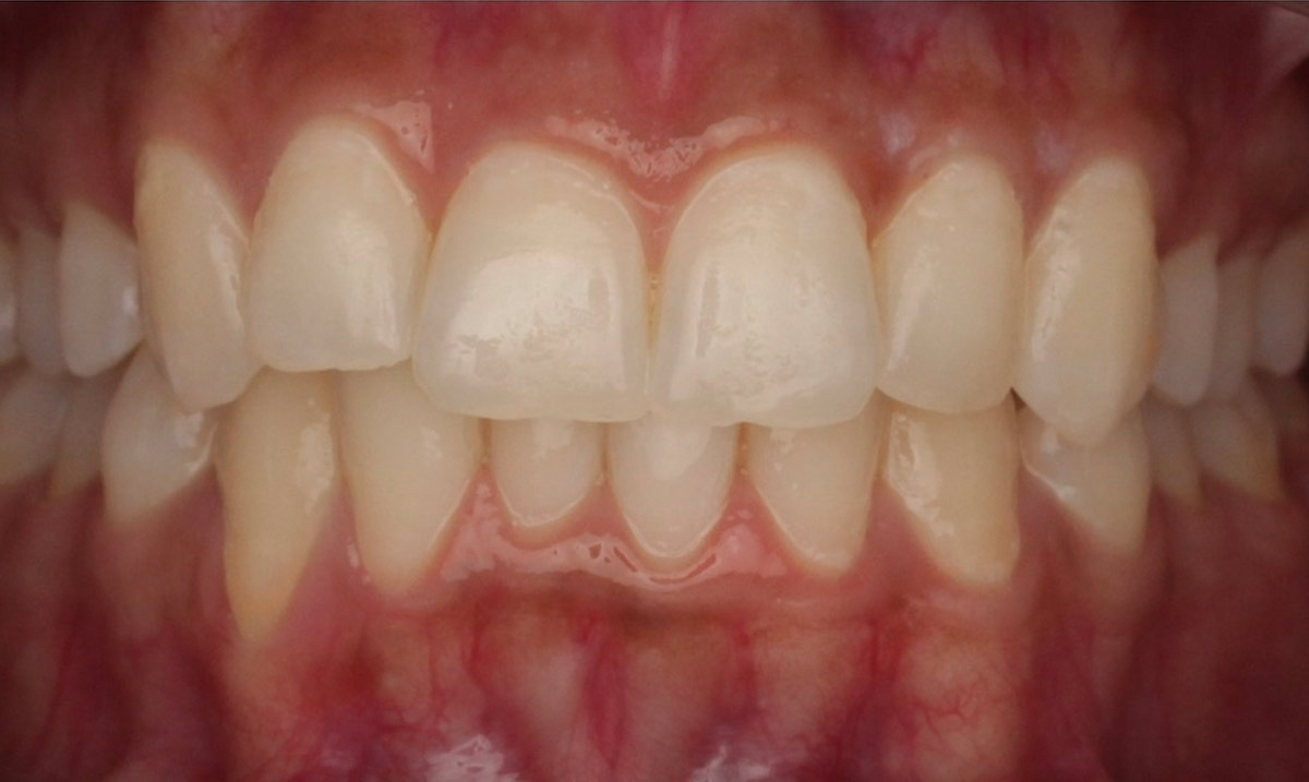 Teeth-Whitening-Before